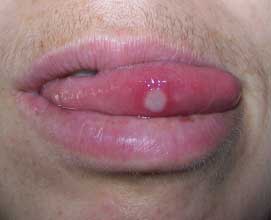 tongue-herpes